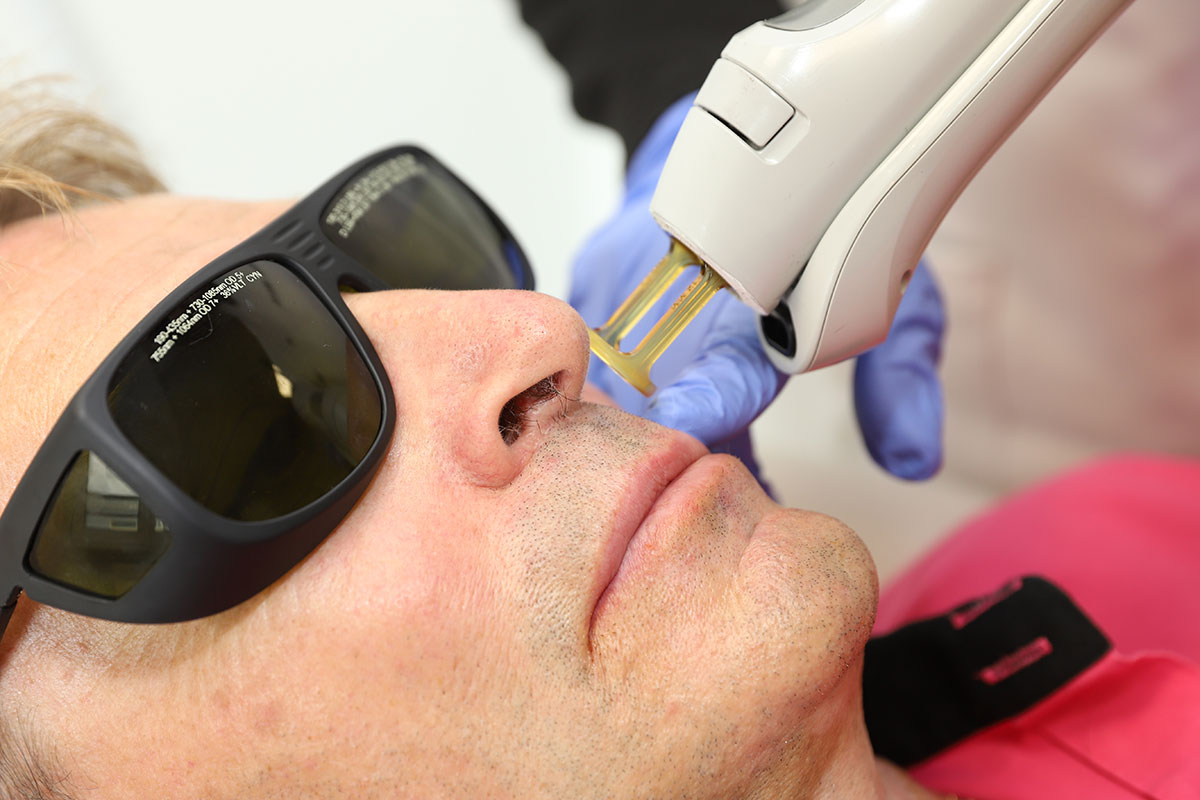 epilation laser medicalee definitive